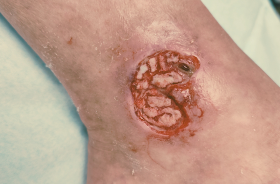 Microinjertos en sello en heridas de difícil cicatrización