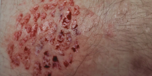 microinjerto en sello
